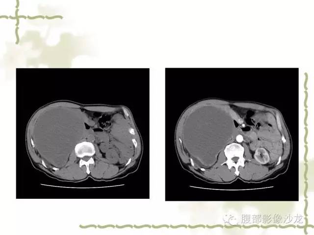 【病例】十二指肠间质瘤1例CT影像表现 【病例】十二指肠间质瘤1例CT影像表现