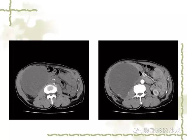 【病例】十二指肠间质瘤1例CT影像表现 【病例】十二指肠间质瘤1例CT影像表现