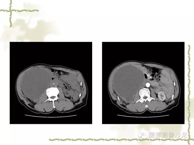 【病例】十二指肠间质瘤1例CT影像表现 【病例】十二指肠间质瘤1例CT影像表现