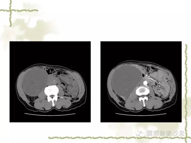 【病例】十二指肠间质瘤1例CT影像表现 【病例】十二指肠间质瘤1例CT影像表现
