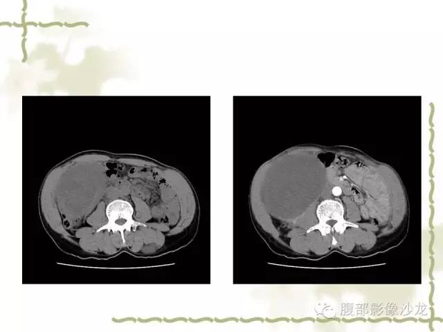 【病例】十二指肠间质瘤1例CT影像表现 【病例】十二指肠间质瘤1例CT影像表现