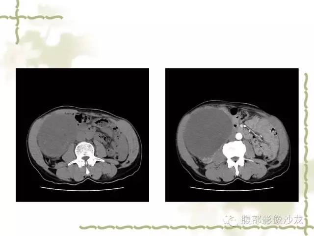 【病例】十二指肠间质瘤1例CT影像表现 【病例】十二指肠间质瘤1例CT影像表现