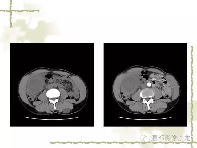 【病例】十二指肠间质瘤1例CT影像表现 【病例】十二指肠间质瘤1例CT影像表现