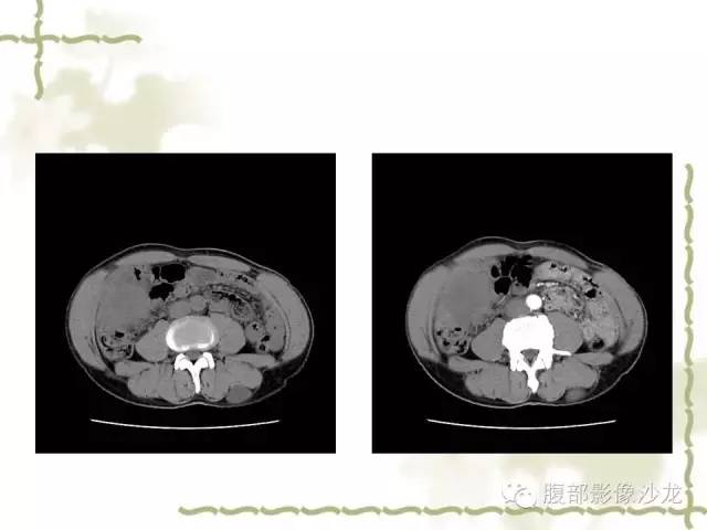 【病例】十二指肠间质瘤1例CT影像表现 【病例】十二指肠间质瘤1例CT影像表现