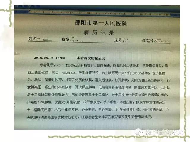 【病例】十二指肠间质瘤1例CT影像表现 【病例】十二指肠间质瘤1例CT影像表现