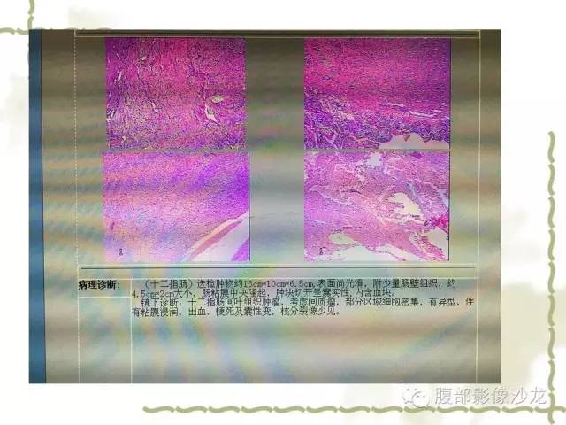 【病例】十二指肠间质瘤1例CT影像表现 【病例】十二指肠间质瘤1例CT影像表现