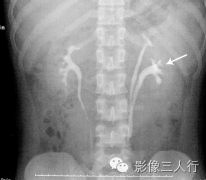 枯萎百合征