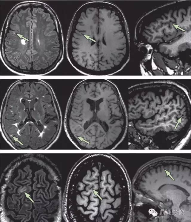 MAGNIMS 共识:多发性硬化 MRI 诊断标准更新要点 MAGNIMS 共识:多发性硬化 MRI 诊断标准更新要点