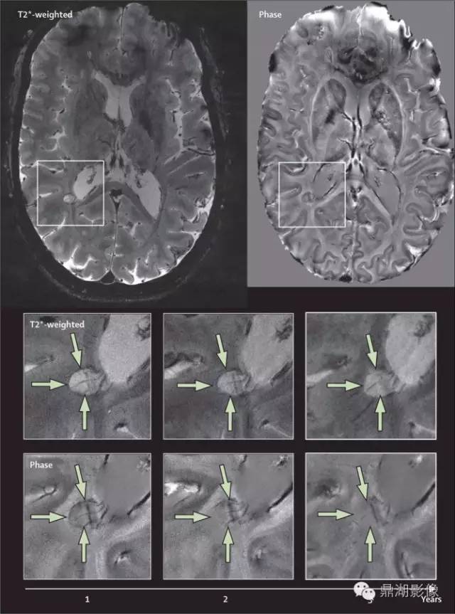 MAGNIMS 共识:多发性硬化 MRI 诊断标准更新要点 MAGNIMS 共识:多发性硬化 MRI 诊断标准更新要点