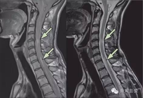 MAGNIMS 共识：多发性硬化 MRI 诊断标准更新要点