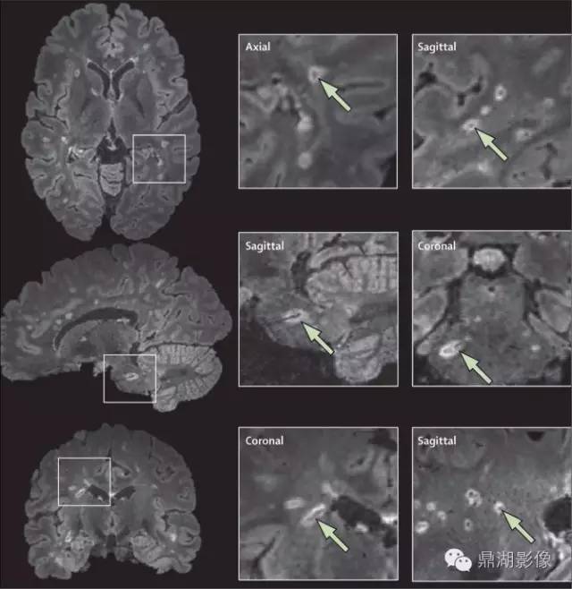 MAGNIMS 共识:多发性硬化 MRI 诊断标准更新要点 MAGNIMS 共识:多发性硬化 MRI 诊断标准更新要点