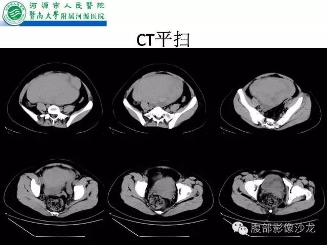 【病例】卵巢浆液性囊腺癌1例CT影像表现