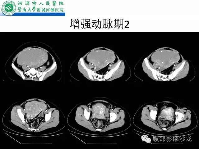 【病例】卵巢浆液性囊腺癌1例CT影像表现