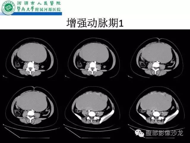 【病例】卵巢浆液性囊腺癌1例CT影像表现