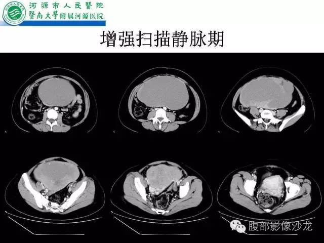 【病例】卵巢浆液性囊腺癌1例CT影像表现
