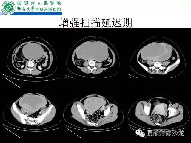 【病例】卵巢浆液性囊腺癌1例CT影像表现