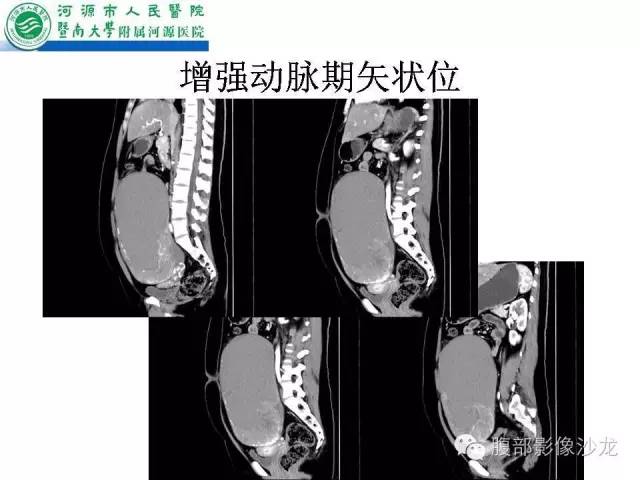 【病例】卵巢浆液性囊腺癌1例CT影像表现