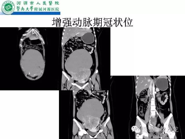 【病例】卵巢浆液性囊腺癌1例CT影像表现