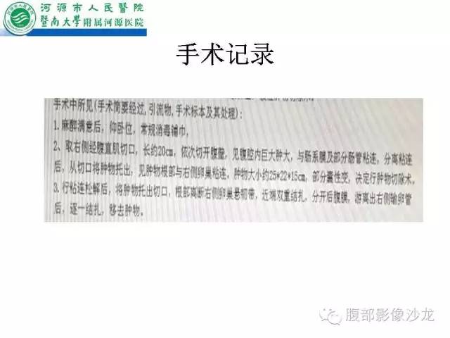 【病例】卵巢浆液性囊腺癌1例CT影像表现