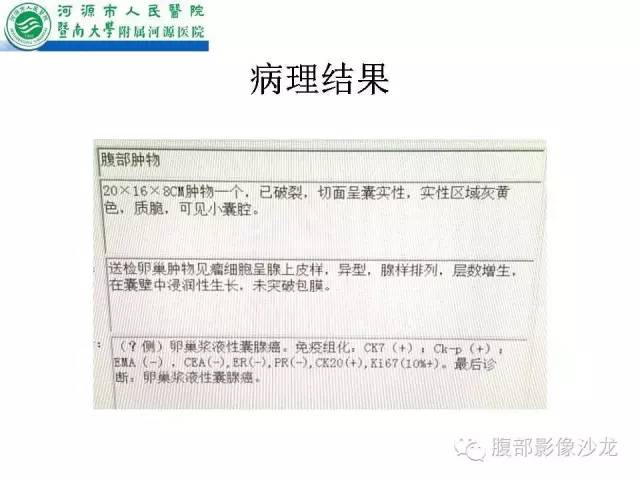【病例】卵巢浆液性囊腺癌1例CT影像表现