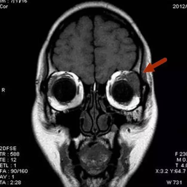 【病例】眼眶炎性假瘤1例MR影像表现与鉴别 【病例】眼眶炎性假瘤1例MR影像表现与鉴别