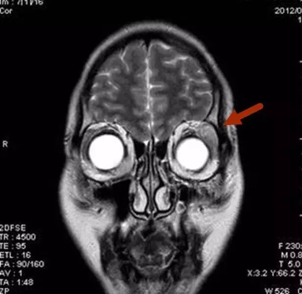 【病例】眼眶炎性假瘤1例MR影像表现与鉴别 【病例】眼眶炎性假瘤1例MR影像表现与鉴别