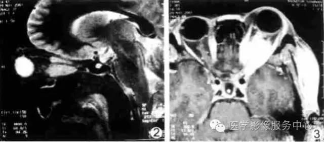 【病例】眼眶炎性假瘤1例MR影像表现与鉴别 【病例】眼眶炎性假瘤1例MR影像表现与鉴别