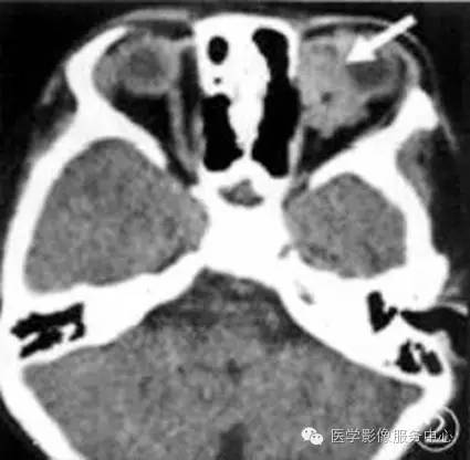 【病例】眼眶炎性假瘤1例MR影像表现与鉴别 【病例】眼眶炎性假瘤1例MR影像表现与鉴别