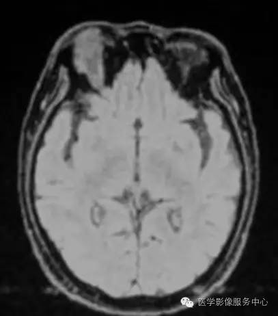 【病例】眼眶炎性假瘤1例MR影像表现与鉴别 【病例】眼眶炎性假瘤1例MR影像表现与鉴别