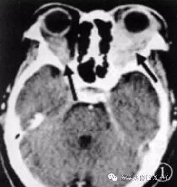 【病例】眼眶炎性假瘤1例MR影像表现与鉴别 【病例】眼眶炎性假瘤1例MR影像表现与鉴别