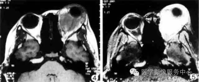 【病例】眼眶炎性假瘤1例MR影像表现与鉴别 【病例】眼眶炎性假瘤1例MR影像表现与鉴别