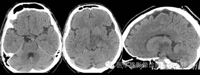 【病例】中枢神经系统结核瘤一例CT及MR影像表现
