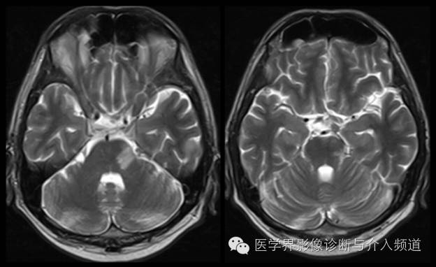 【病例】中枢神经系统结核瘤一例CT及MR影像表现 【病例】中枢神经系统结核瘤一例CT及MR影像表现