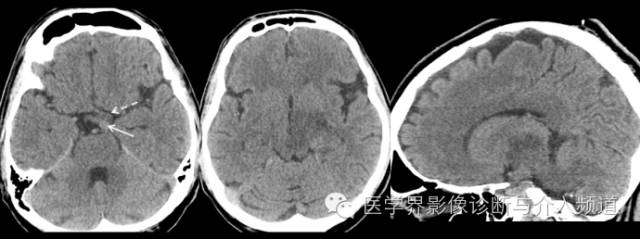 【病例】中枢神经系统结核瘤一例CT及MR影像表现 【病例】中枢神经系统结核瘤一例CT及MR影像表现