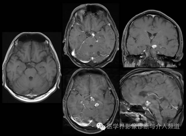 【病例】中枢神经系统结核瘤一例CT及MR影像表现 【病例】中枢神经系统结核瘤一例CT及MR影像表现