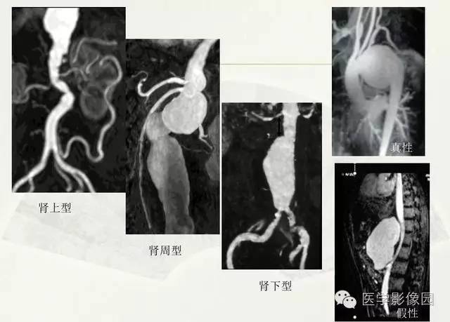 【PPT】大血管疾病的MR诊断