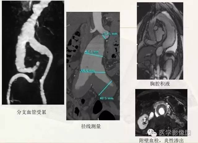 【PPT】大血管疾病的MR诊断