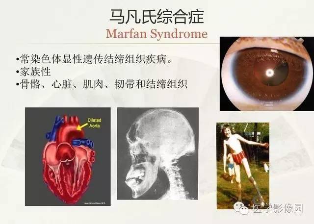 【PPT】大血管疾病的MR诊断
