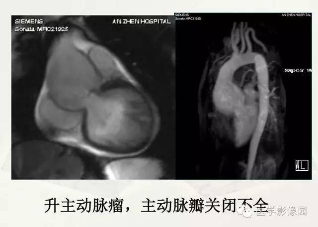 【PPT】大血管疾病的MR诊断