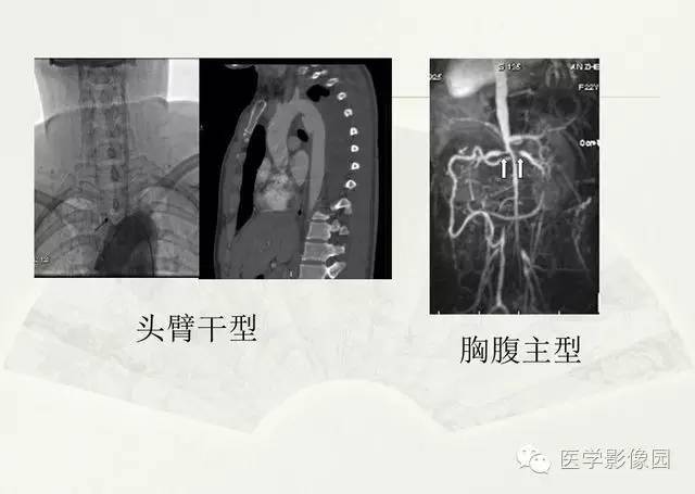 【PPT】大血管疾病的MR诊断