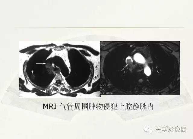 【PPT】大血管疾病的MR诊断