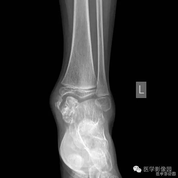 【病例】半肢骨骺异样增殖2例X线影像表现
