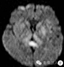 【病例】乙型脑炎1例MR影像表现