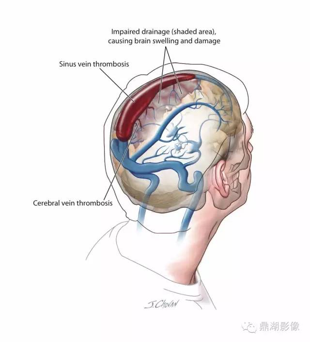 高清头颅静脉系统解剖 高清头颅静脉系统解剖