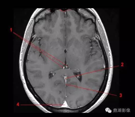 高清头颅静脉系统解剖 高清头颅静脉系统解剖