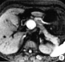 【病例】胰头神经鞘瘤1例MR影像表现