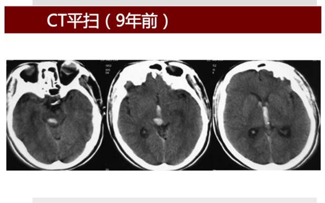 【病例】硬脑膜动静脉瘘1例