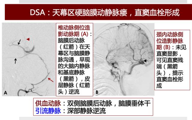 【病例】硬脑膜动静脉瘘1例