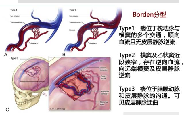 【病例】硬脑膜动静脉瘘1例