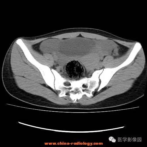 【病例】卵巢内胚窦瘤1例CT影像表现 【病例】卵巢内胚窦瘤1例CT影像表现